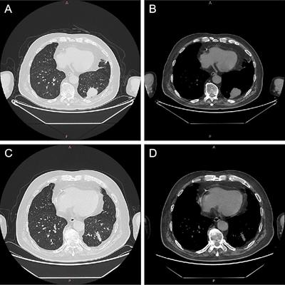 Myasthenia gravis complicated with pulmonary infection by Nocardia cyriacigeorgica: a case report and literature review